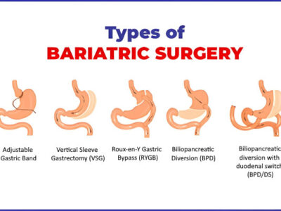 Types of Bariatric Surgery