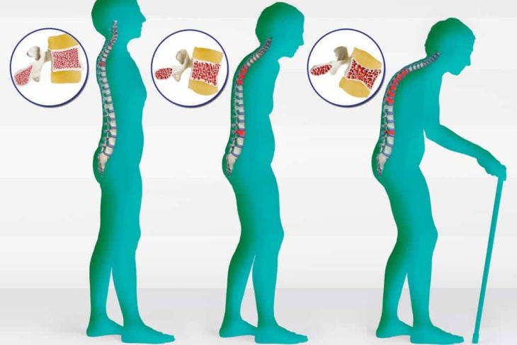 What is Osteoporosis and Why You Should be Tested?
